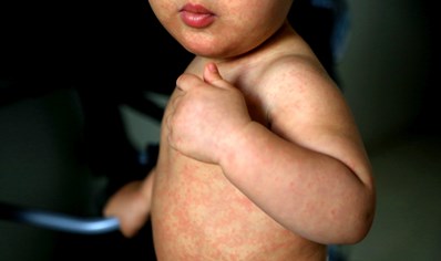 le-preocupa-el-sarampión-asegúrese-de-que-su-hijo-reciba-la-vacuna-mmr image